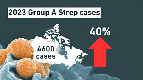 Strep A Cases Skyrocketed This Winter, Here's How It Spreads, Signs To ...