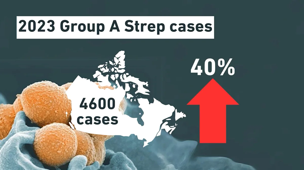 Strep A cases skyrocketed this winter, here's how it spreads, signs to