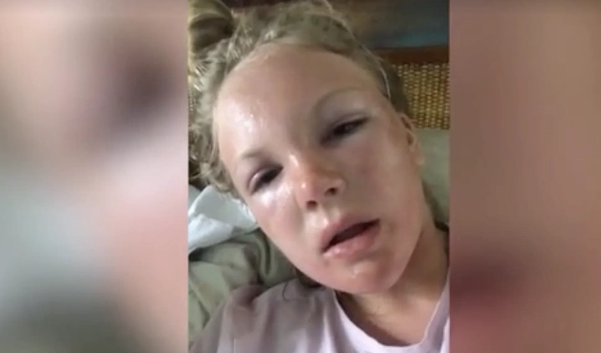 Woman left 'unrecognizable' after painful sun poisoning