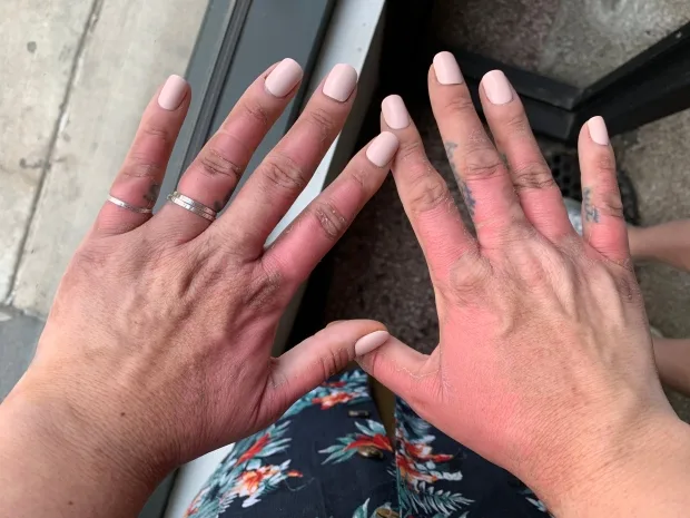Beware of the margarita burn: the unfortunate side effect of limes and sun