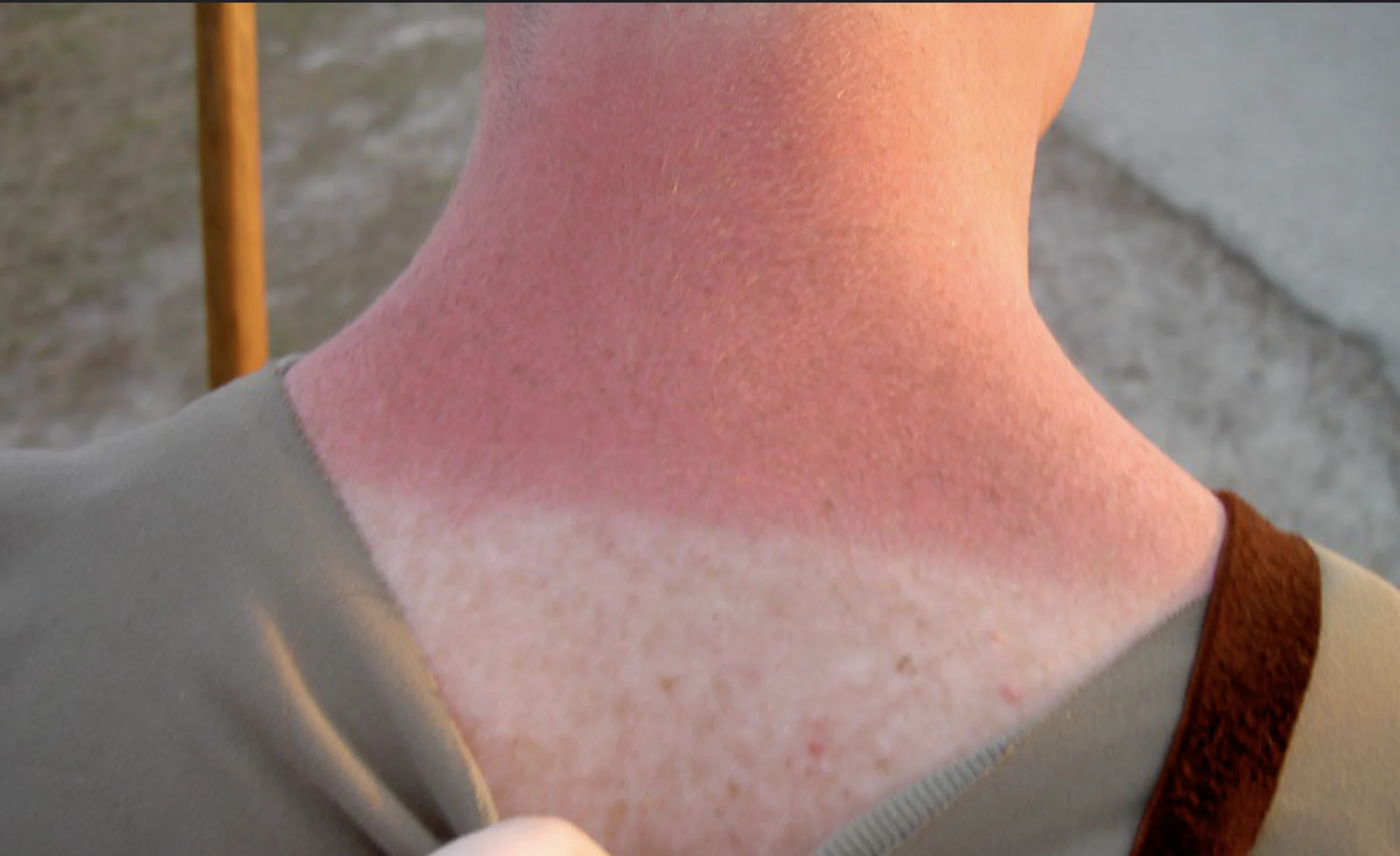 How to treat sunburn pain, according to skin experts