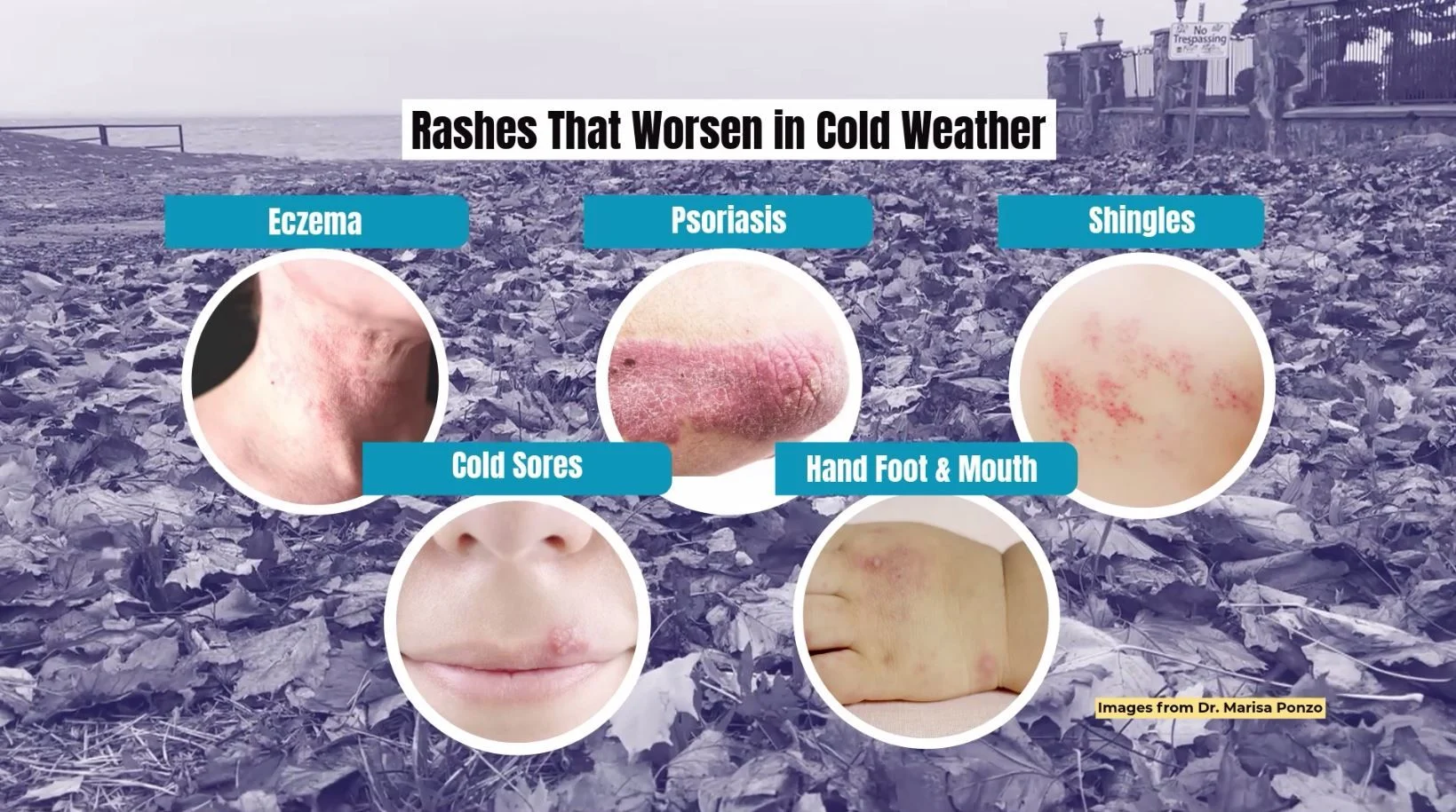Rashes that worsen in cold weather/Rachel S./TWN