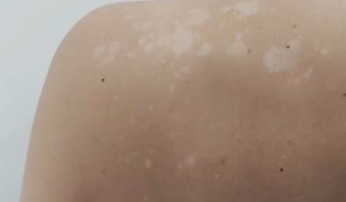 Cet été, gare aux champignons sur votre peau ! - MétéoMédia