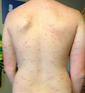 Planning a trip to the lake this summer? Be aware of swimmer's itch